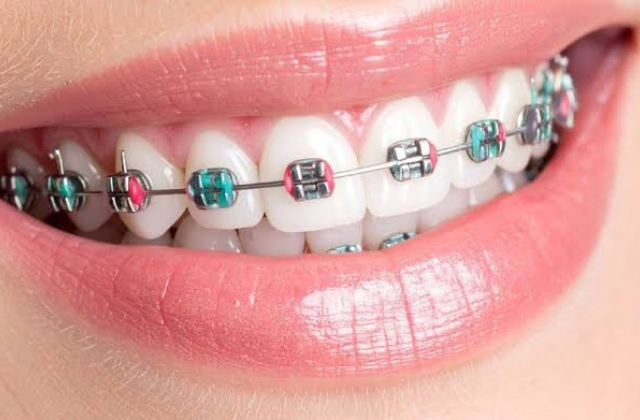 Metal braces