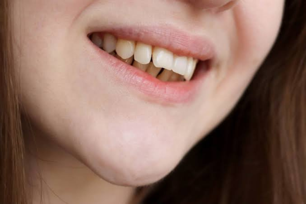 Overbite / underbite