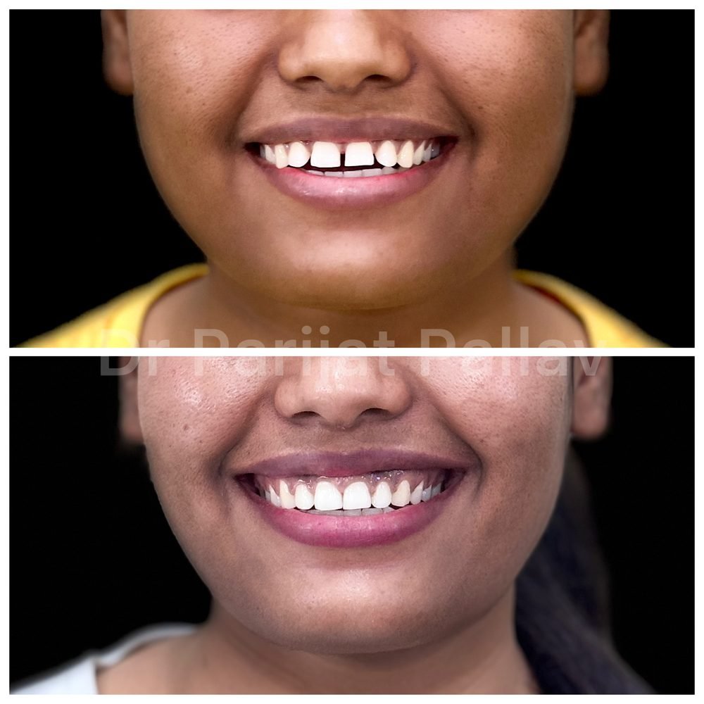 Balaji Dental patient की treatment से पहले और बाद की smile