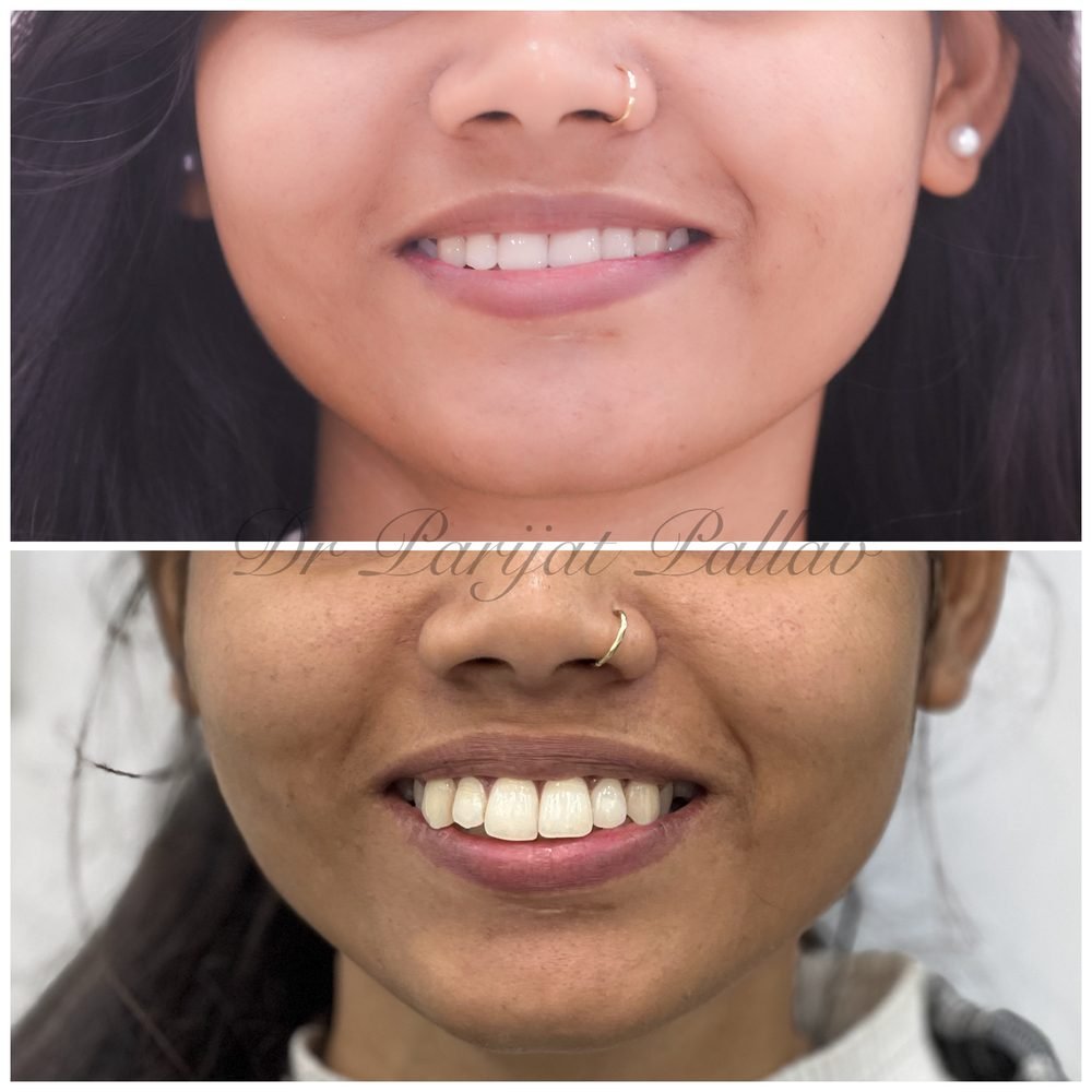 Balaji Dental patient की treatment से पहले और बाद की smile