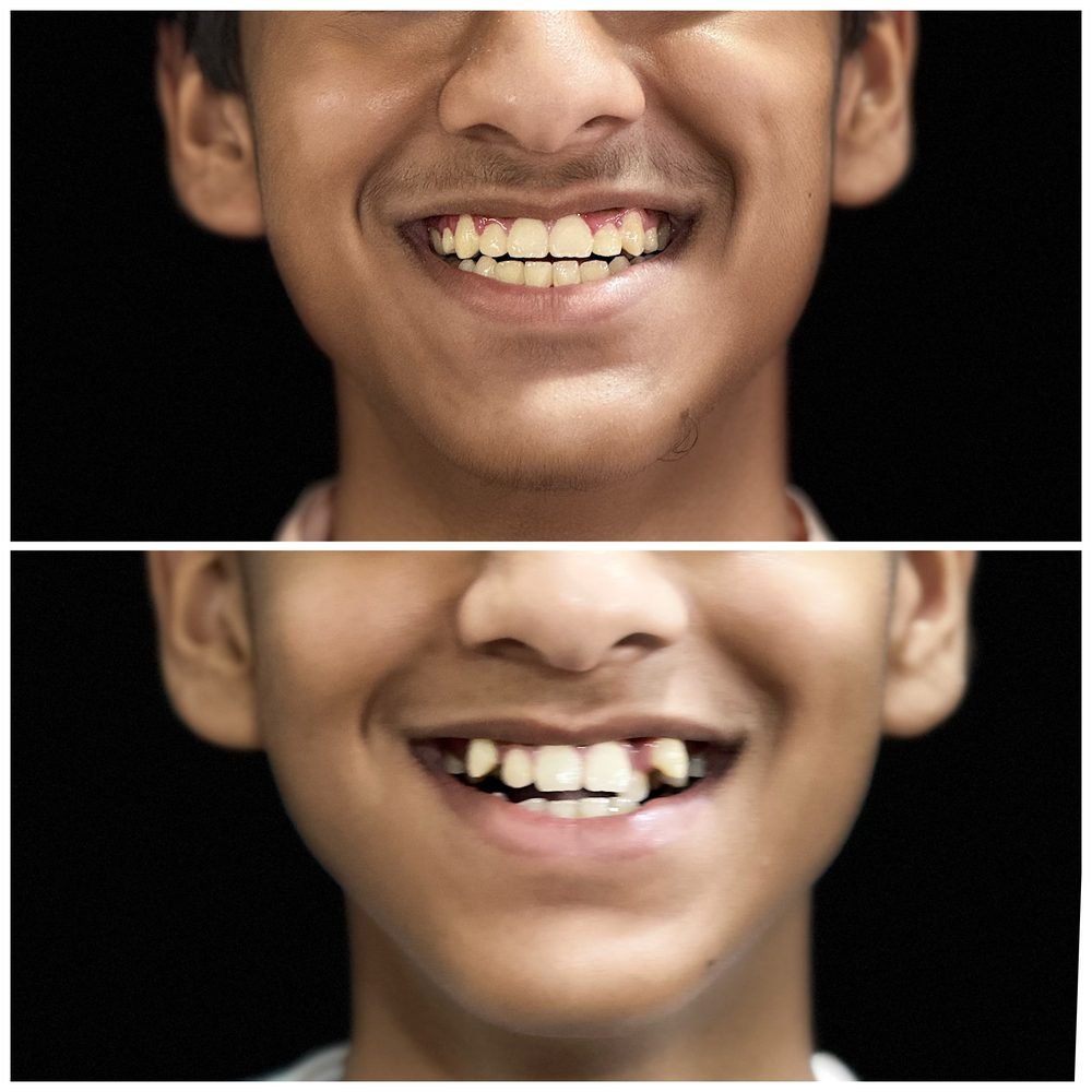 Balaji Dental patient की treatment से पहले और बाद की smile