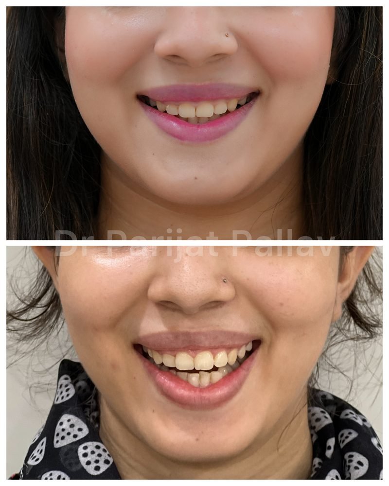 Balaji Dental patient की treatment से पहले और बाद की smile