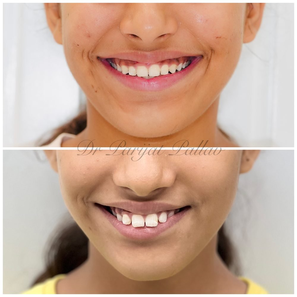 Balaji Dental patient की treatment से पहले और बाद की smile