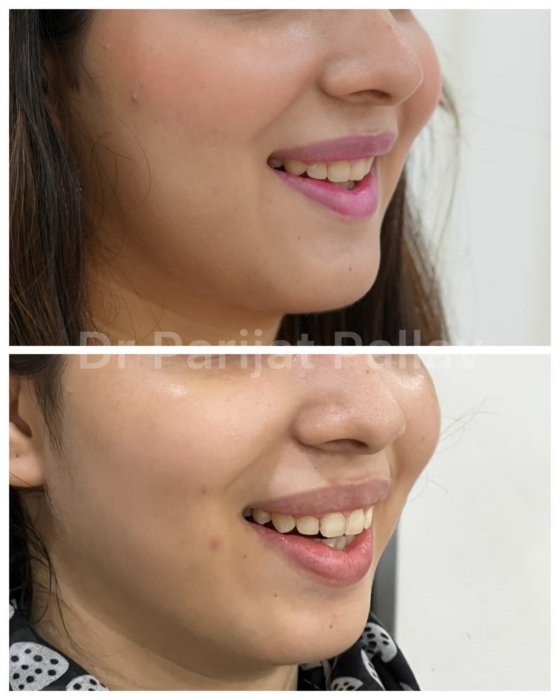 Balaji Dental patient की treatment से पहले और बाद की smile