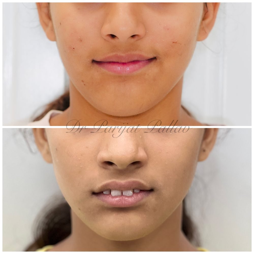 Balaji Dental patient की treatment से पहले और बाद की smile