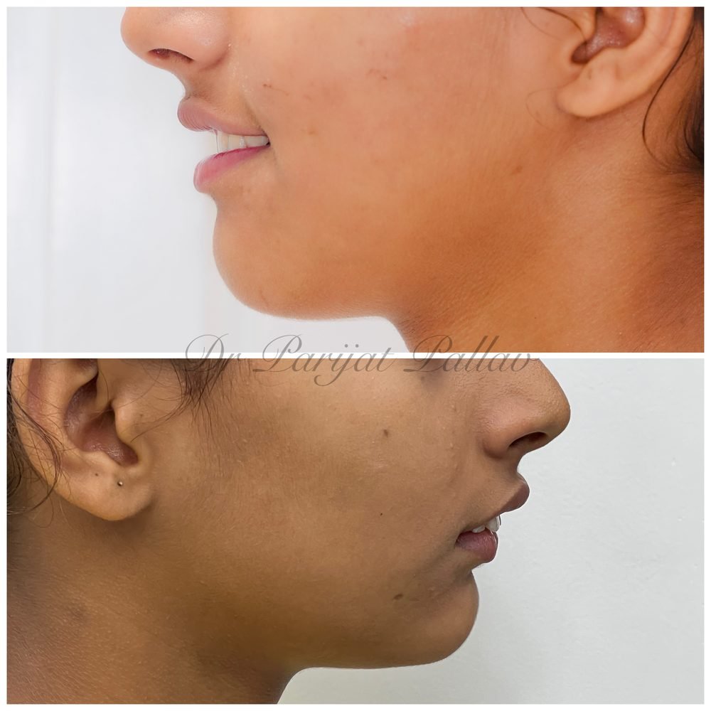 Balaji Dental patient की treatment से पहले और बाद की smile
