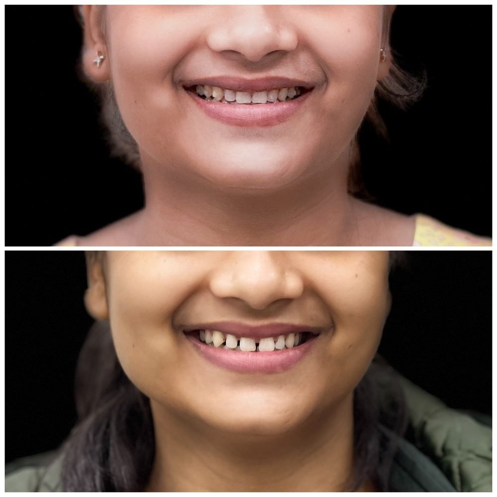 Balaji Dental patient की treatment से पहले और बाद की smile