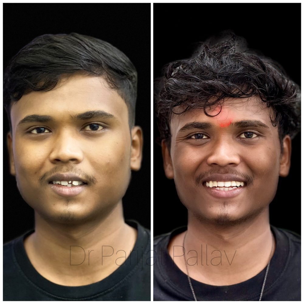 Balaji Dental patient की treatment से पहले और बाद की smile