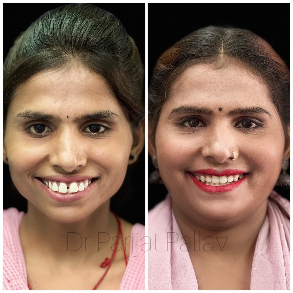 Balaji Dental patient की treatment से पहले और बाद की smile