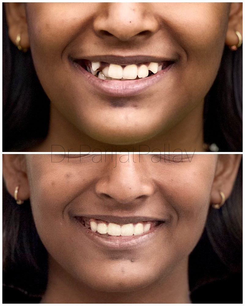 Balaji Dental patient की treatment से पहले और बाद की smile