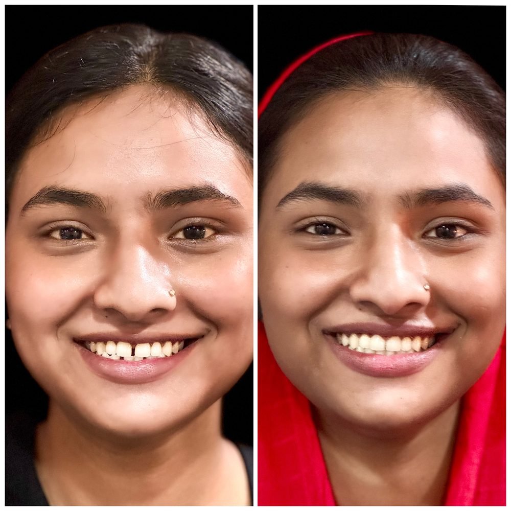 Balaji Dental patient की treatment से पहले और बाद की smile