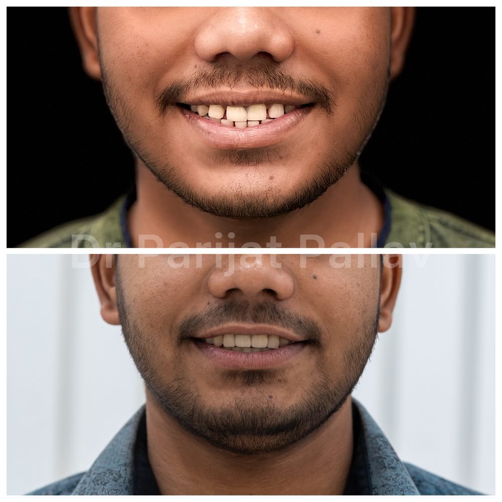 Balaji Dental patient की treatment से पहले और बाद की smile
