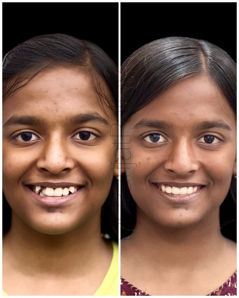 Balaji Dental patient की treatment से पहले और बाद की smile