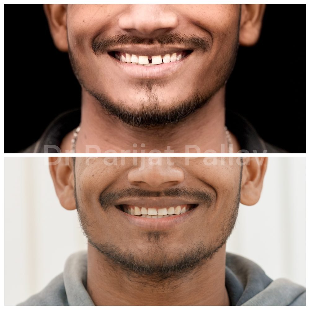 Balaji Dental patient की treatment से पहले और बाद की smile