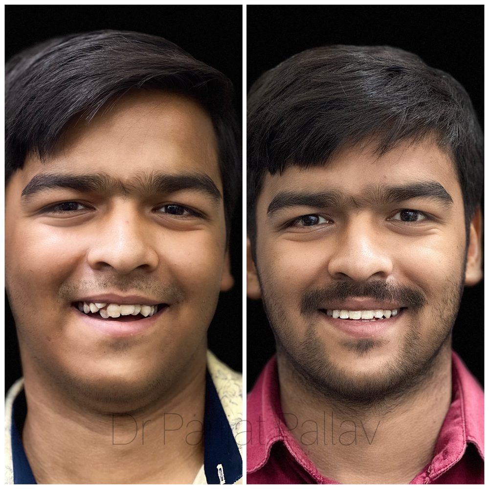 Balaji Dental patient की treatment से पहले और बाद की smile