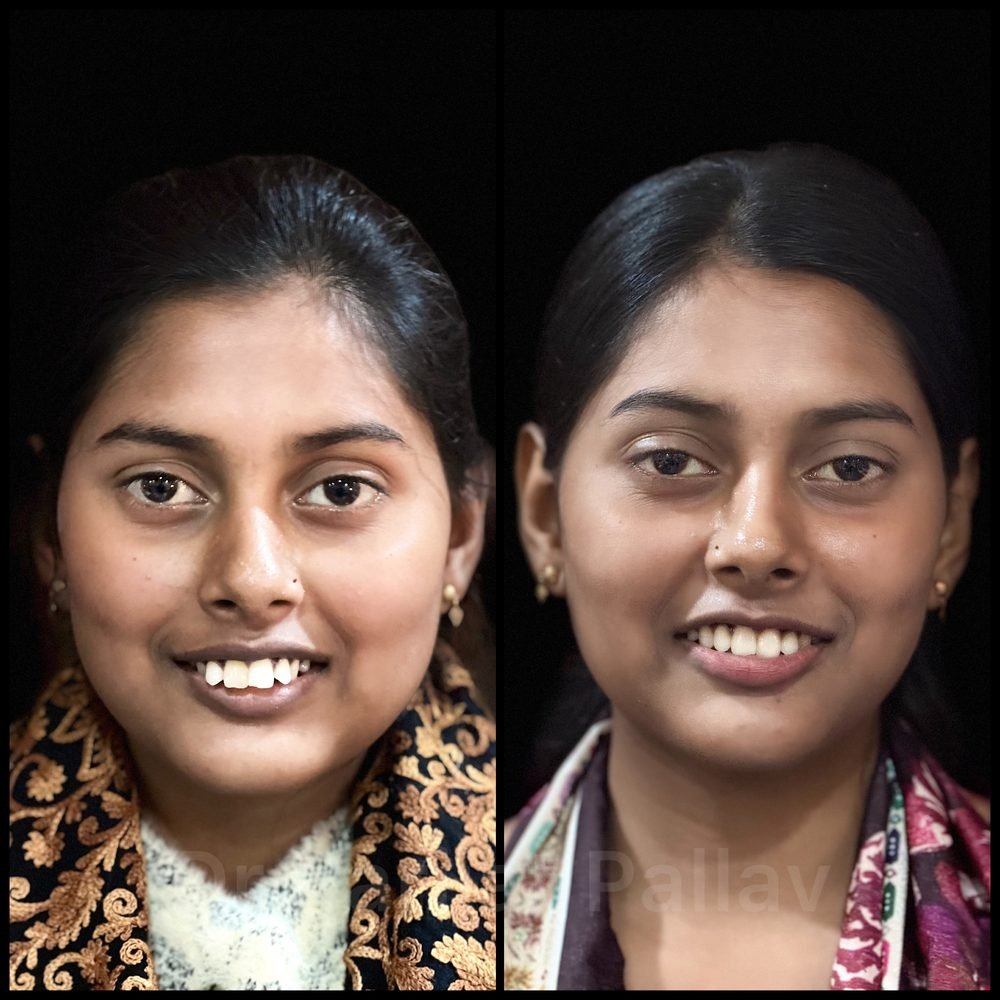 Balaji Dental patient की treatment से पहले और बाद की smile