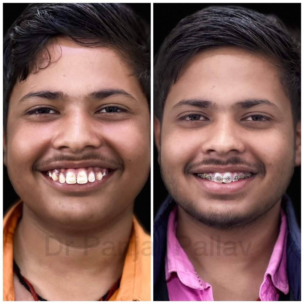 Balaji Dental patient की treatment से पहले और बाद की smile