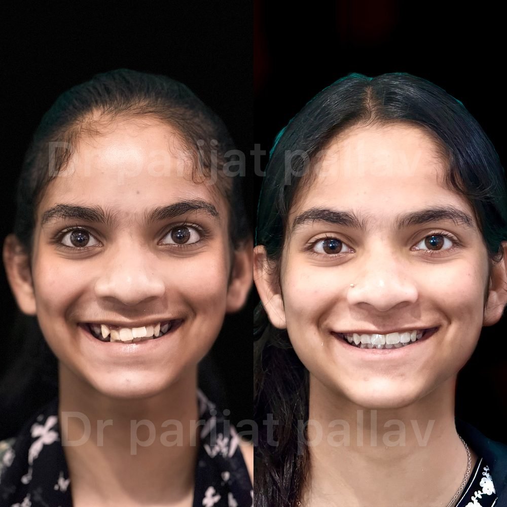 Balaji Dental patient की treatment से पहले और बाद की smile