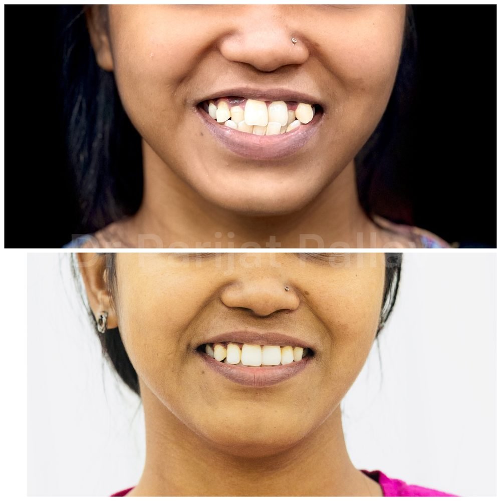 Balaji Dental patient की treatment से पहले और बाद की smile