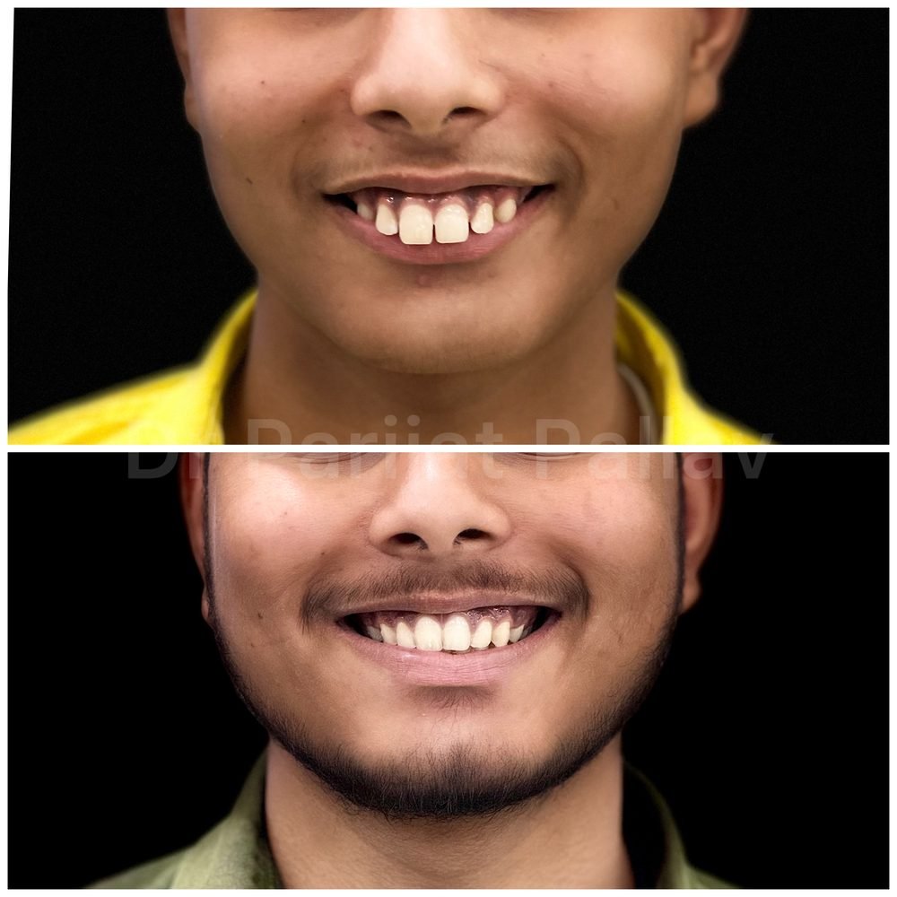 Balaji Dental patient की treatment से पहले और बाद की smile