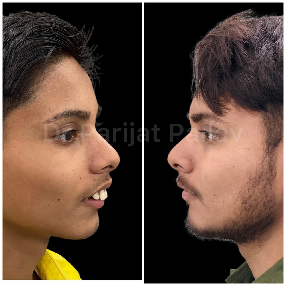 Balaji Dental patient की treatment से पहले और बाद की smile