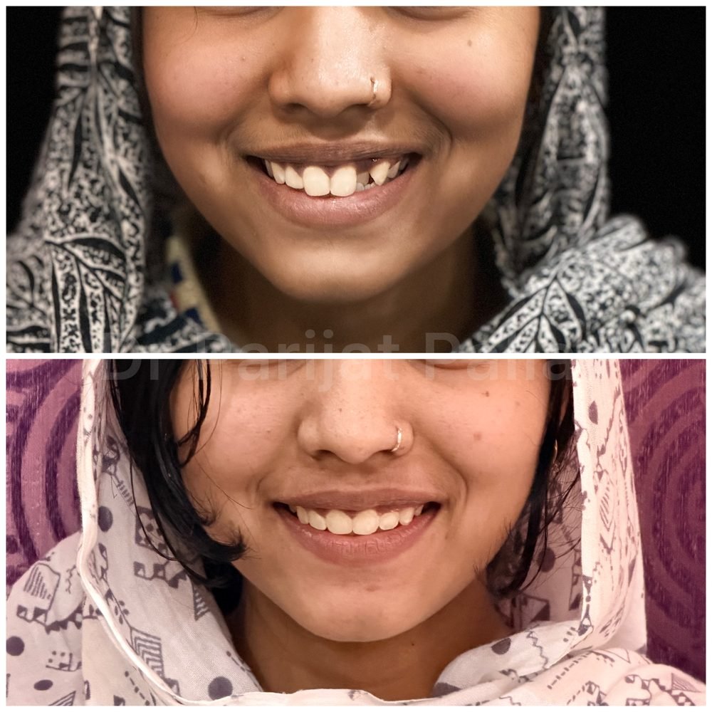 Balaji Dental patient की treatment से पहले और बाद की smile