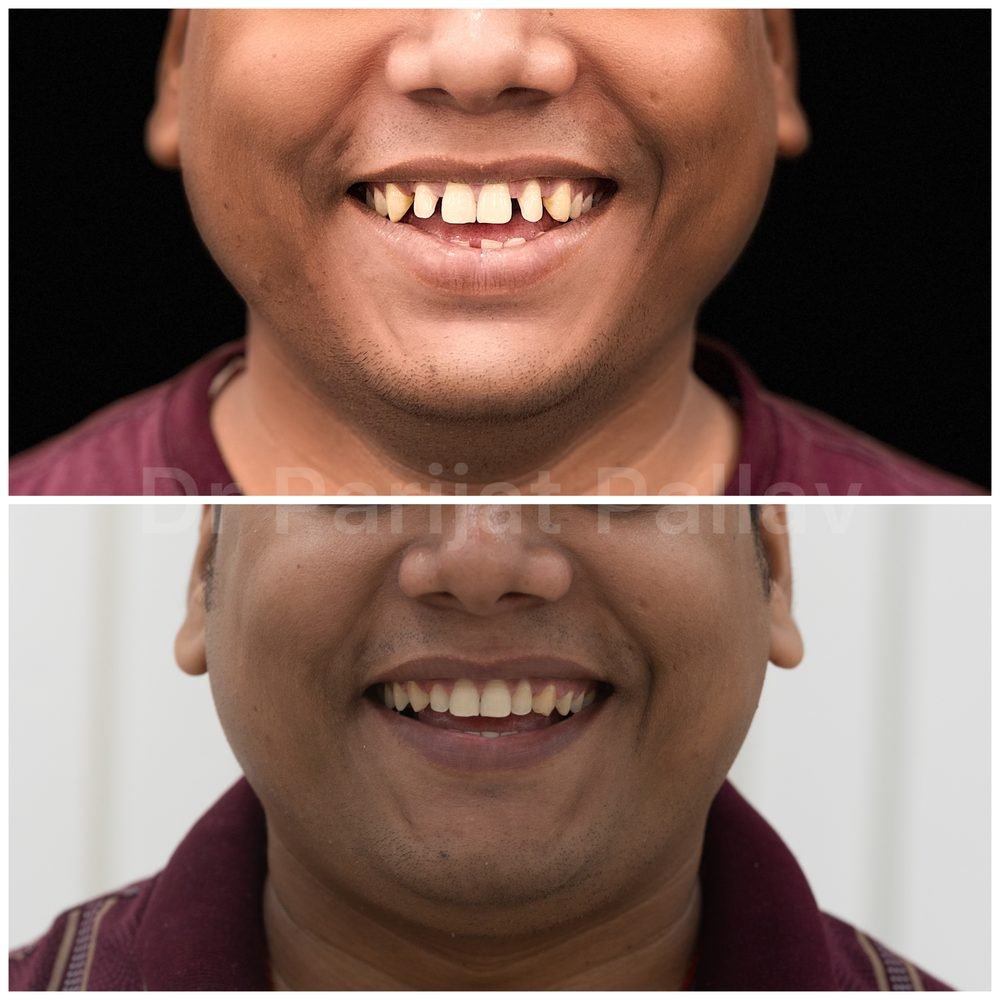 Balaji Dental patient की treatment से पहले और बाद की smile